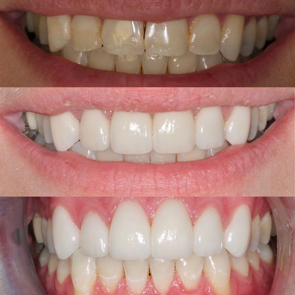 before-and-after-21-woodbridge-comfort-dental-care