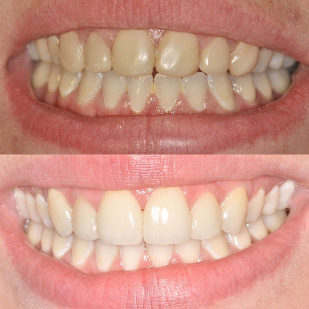before-and-after-24-woodbridge-comfort-dental-care