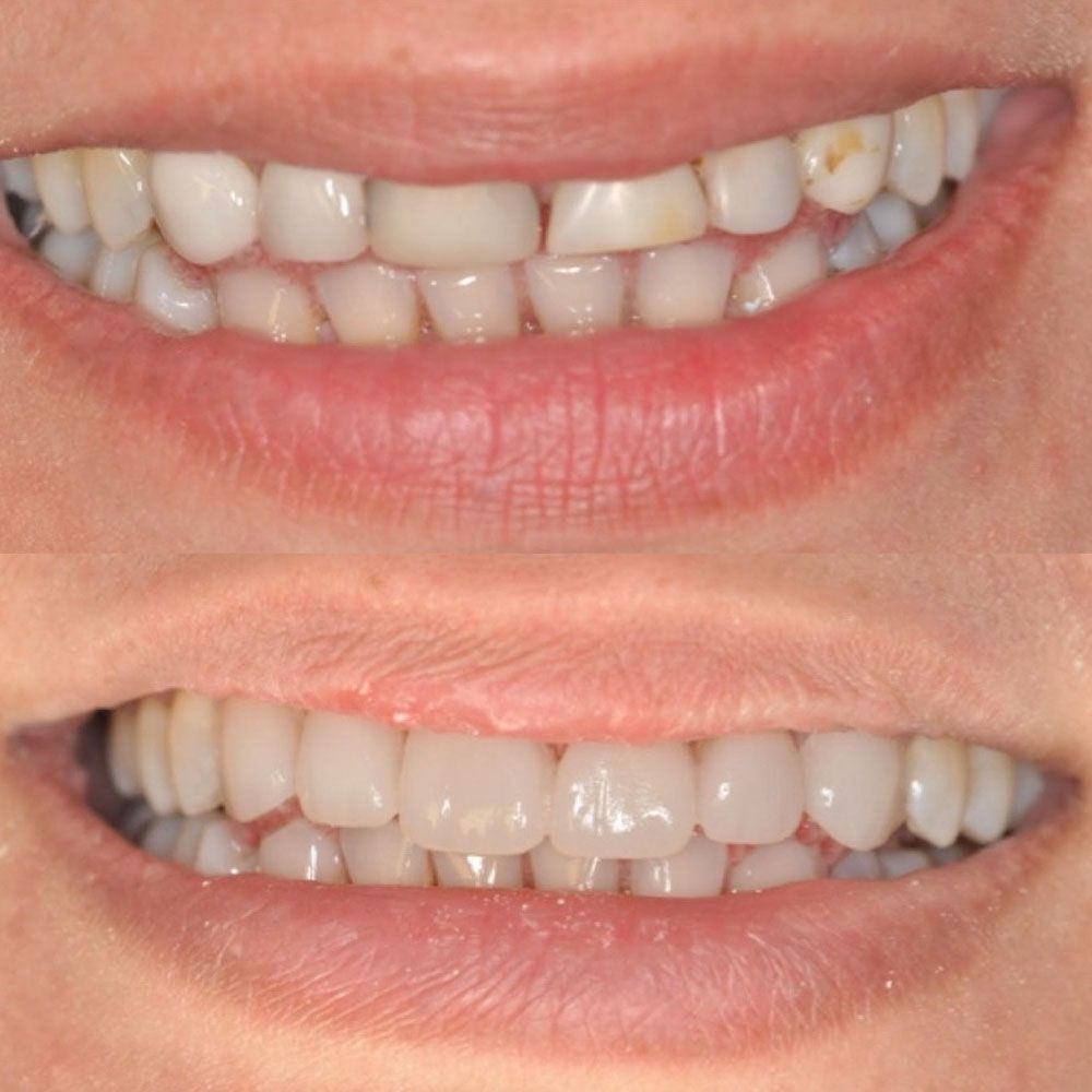 before-and-after-28-woodbridge-comfort-dental-care