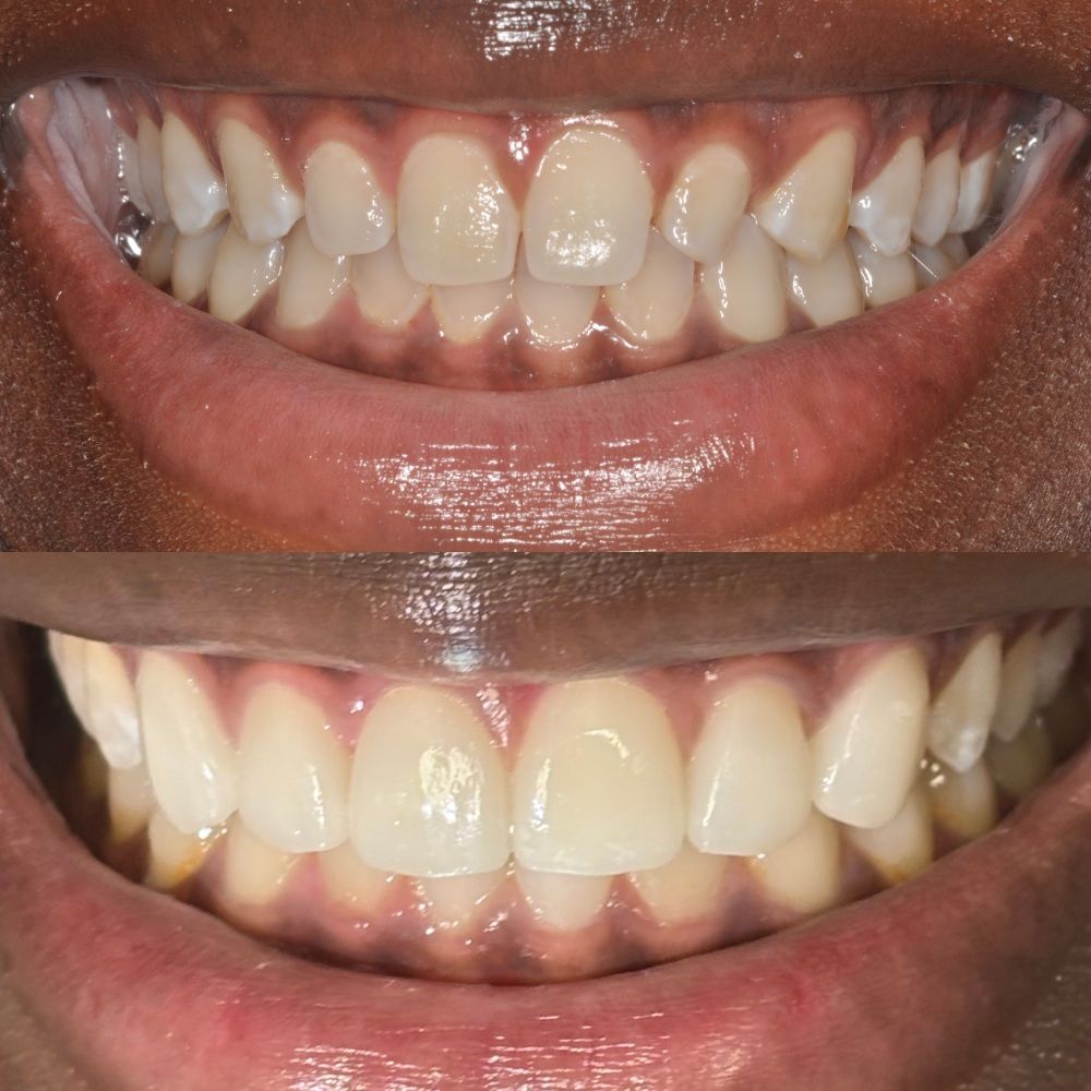 veneers-before-and-after